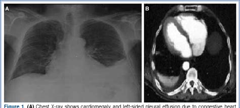 Figure 1 From Development Of Chylothorax And Chylous Ascites In A