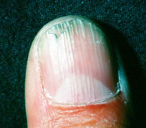 Nail Changes In Atopic Dermatitis
