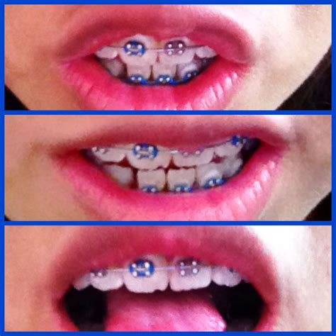 brackets ligas de color azul y morado dientes braces orthodontics lips mouth teeth tooth