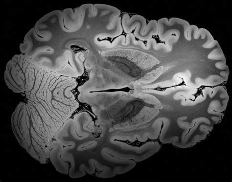 Ultra High Resolution Mri Of Human Brain Sets New Heights