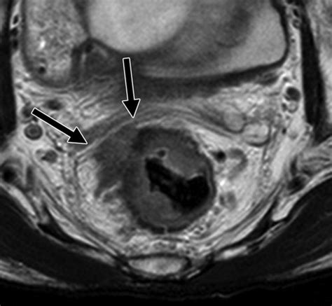 Restaging Of Rectal Cancer With Mr Imaging After Concurrent Chemotherapy And Radiation Therapy
