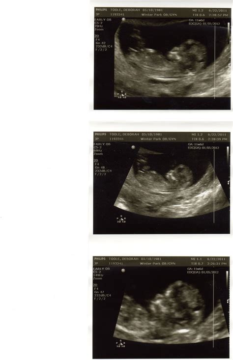 I wouldn't take an early scan as read, as it's not your official dating scan anyway. does it get more accurate as you get more pregnant? Growth of a Sprout: Baby girl ultrasound pictures