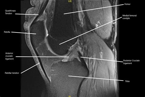 Posterior Cruciate Ligament Injury Complete Orthopedics