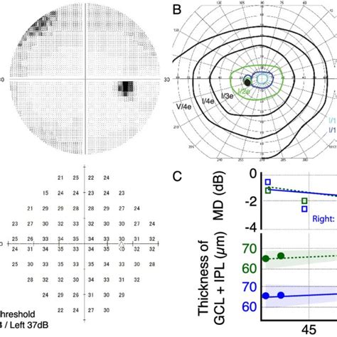 Visual Field Testing And Retinal Thickness A Humphrey Visual Field