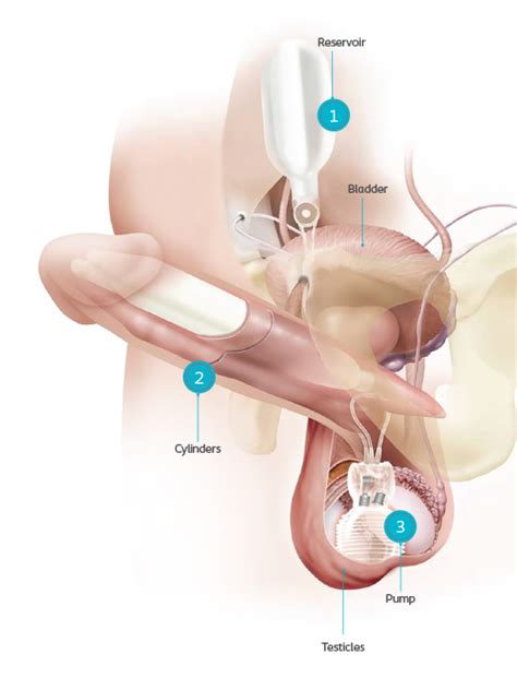 About The Internal Penile Pump Kienitvc Ac Ke