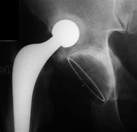 Chronic Asymptomatic Dislocation Of A Total Hip Replacement A Case