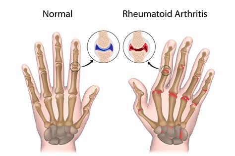 Rheumatoid Arthritis Of Hand Morada Senior Living