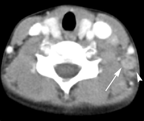 Kikuchi Disease Differentiation From Tuberculous Lymphadenitis Based