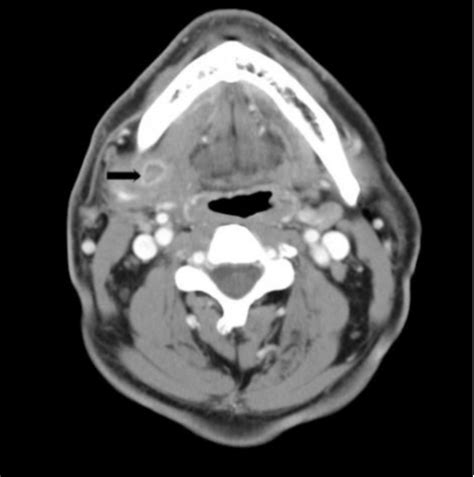 Ct Scan Of The Neck With Contrast Showing A Ring Enhancing Lesion On