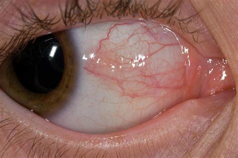 Episcleritis Of The Eye Photograph By Dr P Marazziscience Photo Library