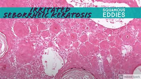 Irritated Seborrheic Keratosis Squamous Eddies 5 Minute Pathology