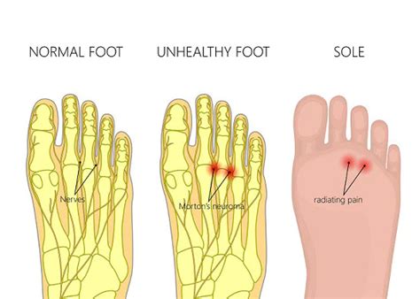 Morton’s Neuroma And Ball Of Foot Pain An Tâm