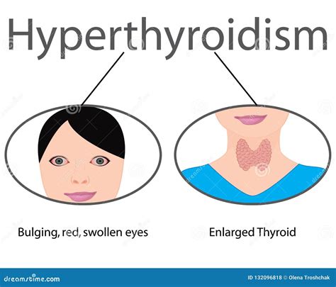 Hyperthyroidism Enlarged Thyroid Endocrine Disfunction Vector
