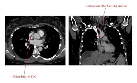 Ct Angiography Of The Chest Showing A Filling Defect In The Svc And