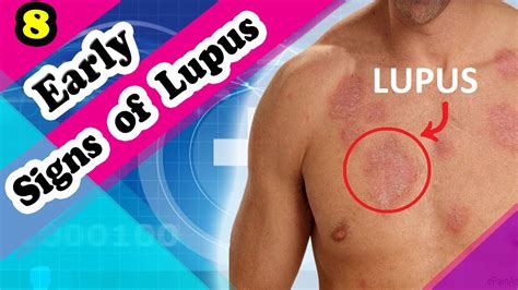 7 Signs And Symptoms Of Lupus You Should Know Youtube