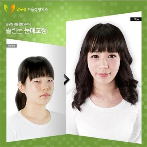 Crazy Before And After Photos Of Korean Plastic Surgery Korean Plastic Surgery Plastic