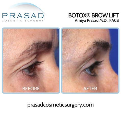 Can Plastic Surgery Fix Hooded Eyes Prasad Cosmetic Surgery