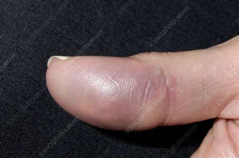 Fractured Thumb Stock Image M3301515 Science Photo Library