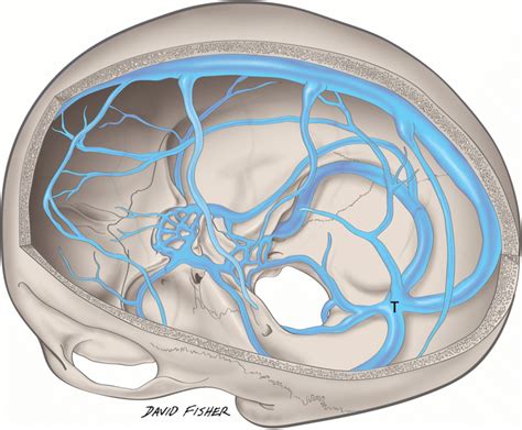 Schematic Drawing Of The Major Dural Venous Sinuses Noting