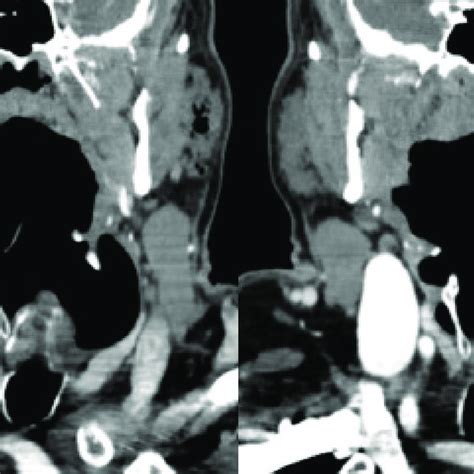 Coronal Contrast Enhanced Computerized Tomography Section Acquired