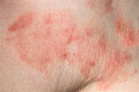 Dermatite De Contato Causas Sintomas E Tratamento Md Sa De Hot Sex