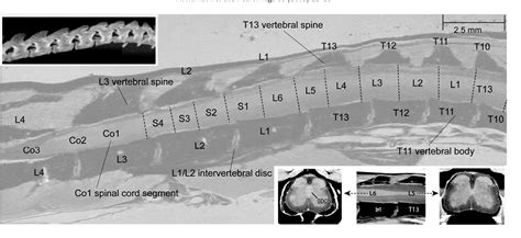 Vertebral Landmarks For The Identification Of Spinal Cord Segments In