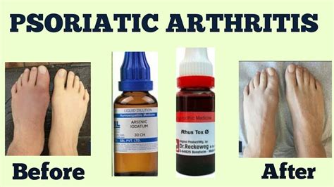 Jessicabattledesigns Who To See For Psoriatic Arthritis