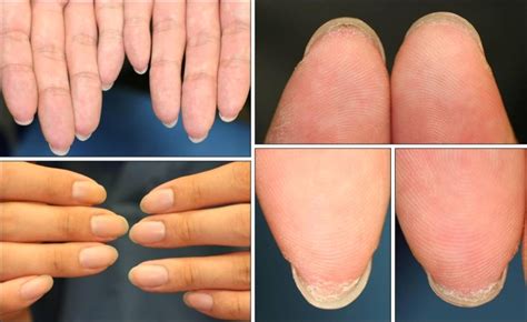 Fingers Showing Adherence Of The Distal Portion Of The Nail Bed To The