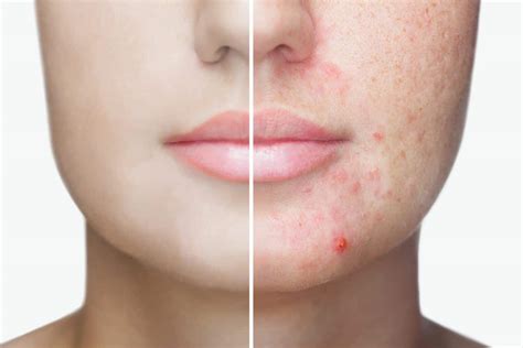 My Approach To Acne Hope Dermatology