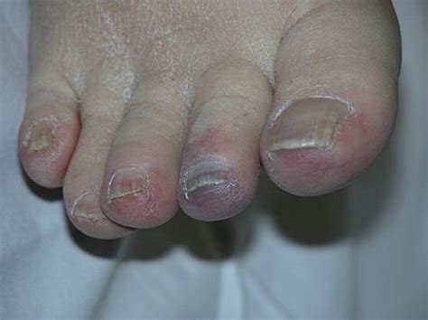 Blue Or Purple Toe Syndrome Journal Of The American Academy Of