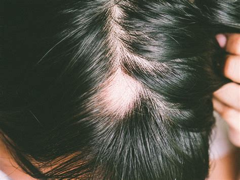 Sores On Scalp Causes With Hair Loss And Treatments American Celiac