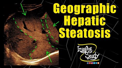 Geographic Hepatic Steatosis Focal Fatty Infiltration Ultrasound