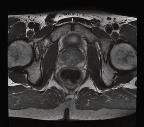 Prostate Mri Insight Medical Imaging