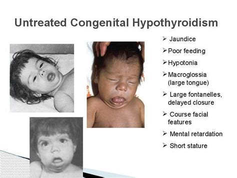 Congenital Hypothyroidism Continue With The Details At The Image