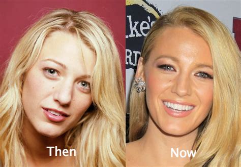 Blake Lively Plastic Surgery Before And After Photos