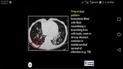 Tree In Bud On Ct Chest Overall Length Logbook Picture Gallery