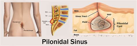 Consult a doctor for medical advice. Pilonidal sinus treatment | Laser surgery for pionidal sinus