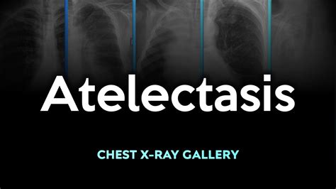 Atelectasis Chest X Ray Images Youtube