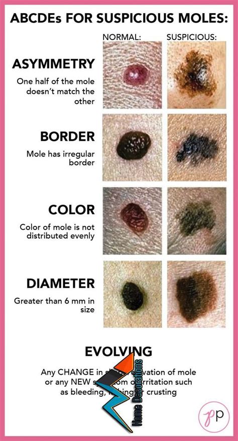 The Abcdes Of Suspicious Moles Skin Disorders Cancerous Moles How Cancers See The Signs