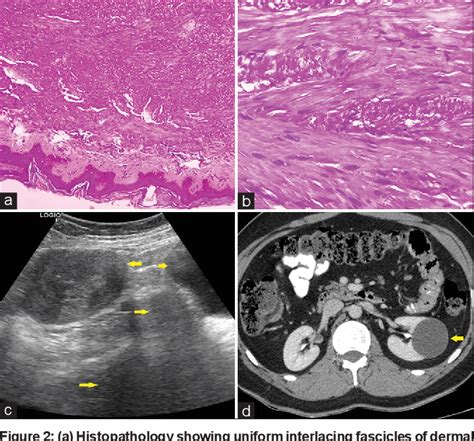 Figure 2 From Reeds Syndrome A Rare Case Of Multiple Cutaneous And