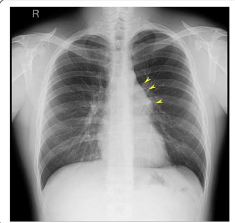 Chest X Ray Showed A Protrusion Of The Aortopulmonary Window