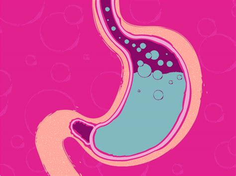 Have you been diagnosed with gastroesophageal reflux disease (gerd)? GERD: Facts, Statistics, and You