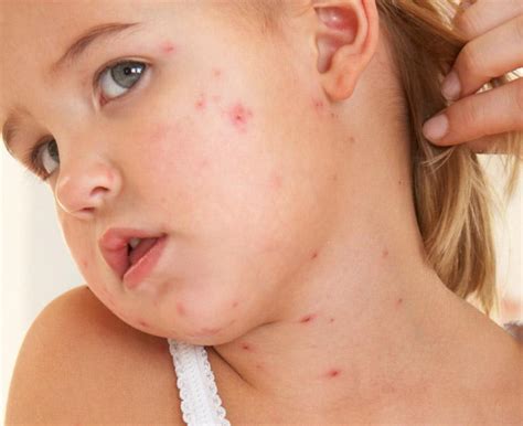 Viral Rashes What You Need To Know Dr Pmgs Blog