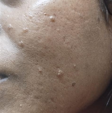 Bumpscystssebaceous Filaments On Face Looking For Suggestions On