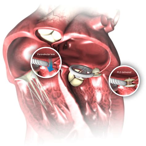 Paravalvular Leak Device Pld Occlutech Every Beat Counts