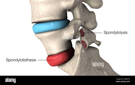 Spondylolisthesis Hi Res Stock Photography And Images Alamy