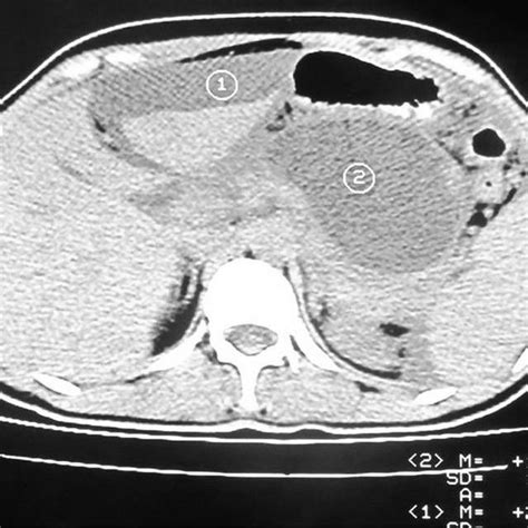 Contrast Abdominal Computed Tomography Scan Showing Pancreatic
