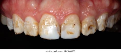 Severe Dental Fluorosis Deformation Enamel Amelogenesis Stock Photo