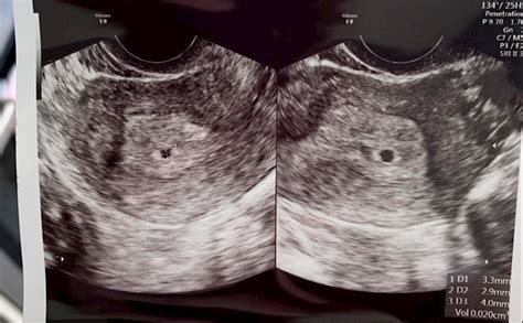 4 Weeks 6 Days Ultrasound This Pregnancy And Par