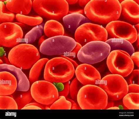Los Glóbulos Rojos Falciformes Alargada Cónica De Células Entre Los